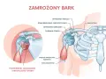 Ilustracja przedstawia zamrożony bark, z zaznaczonym pogrubieniem i zwłóknieniem torebki stawu, co powoduje ból barku.