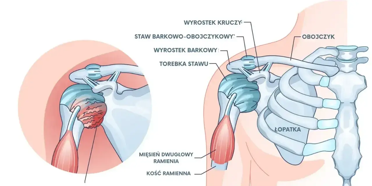 Ilustracja przedstawia zamrożony bark, z zaznaczonym pogrubieniem i zwłóknieniem torebki stawu, co powoduje ból barku.