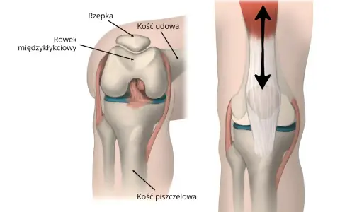 Anatomia stawu rzepkowo udowego: rzepka, kość udowa, rowek międzykłykciowy i kość piszczelowa. Strzałki pokazują ruch.