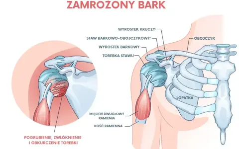 Ilustracja przedstawia zamrożony bark, z zaznaczonym pogrubieniem i zwłóknieniem torebki stawu, co powoduje ból barku.