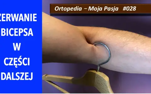 Zerwanie bicepsa w części dalszej. Widoczny hak wbit w mięsień, symbolizujący uraz.