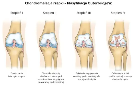 Stopień II chondromalacji rzepki: chrząstka staje się nierówna, z drobnymi szczelinami nie sięgającymi do warstwy podchrzęstnej.