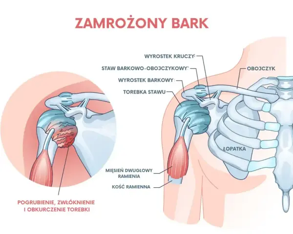 Ilustracja przedstawia zamrożony bark, z zaznaczonym pogrubieniem i zwłóknieniem torebki stawu, co powoduje ból barku.