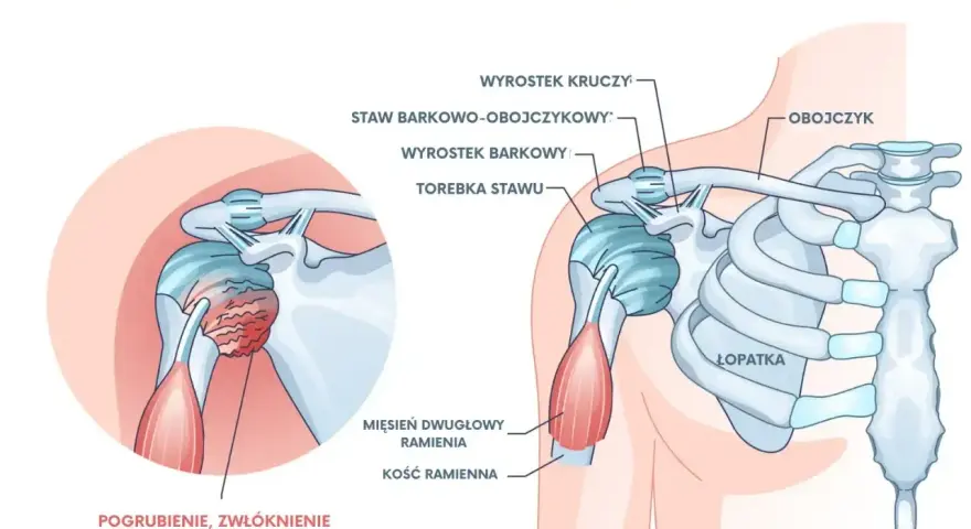 Ilustracja przedstawia zamrożony bark, z zaznaczonym pogrubieniem i zwłóknieniem torebki stawu, co powoduje ból barku.