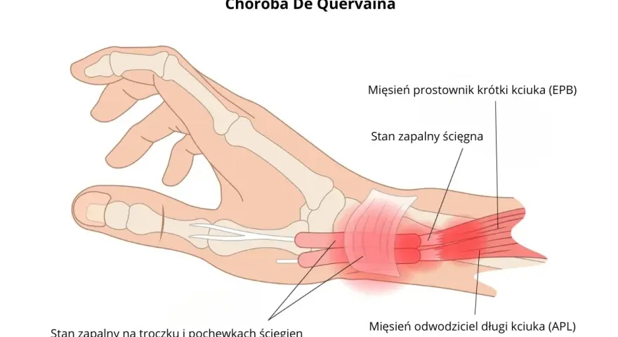 Ilustracja przedstawia zapalenie ścięgna nadgarstka w chorobie De Quervaina, z zaznaczonym stanem zapalnym pochewek ścięgien kciuka.