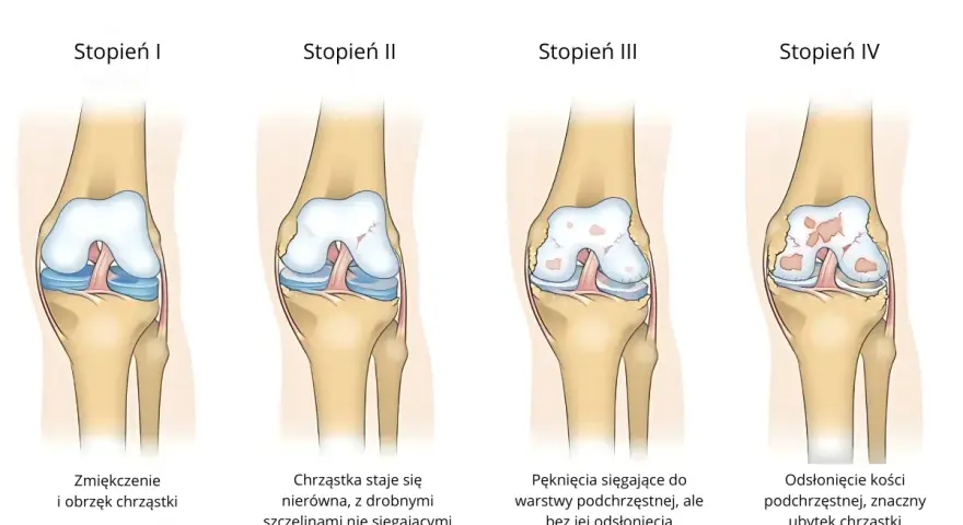 Stopień II chondromalacji rzepki: chrząstka staje się nierówna, z drobnymi szczelinami nie sięgającymi do warstwy podchrzęstnej.